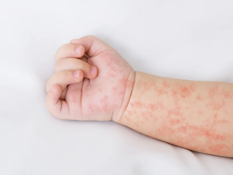 braço crianças com dermatite atópica